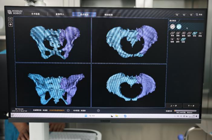 机器人复位后骨盆情况，复位效果满意。