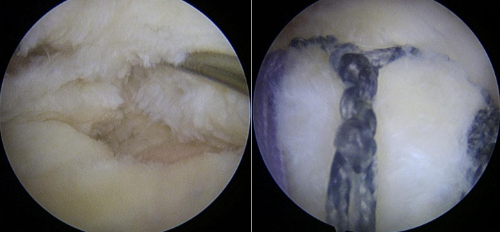 左图：肩袖撕裂口；右图：Y-Loop技术修复完成后，肌腱恢复覆盖，张力均匀
